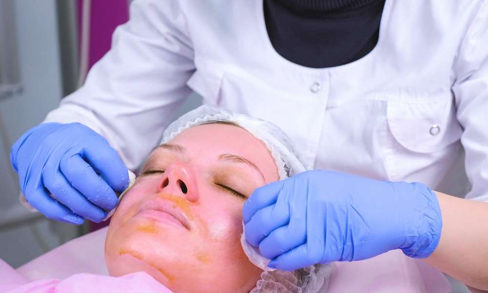 What is the strongest chemical skin peel?